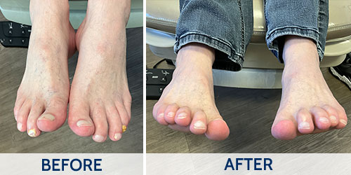 fungal toenails before and after