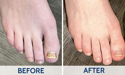 fungal toenails before and after