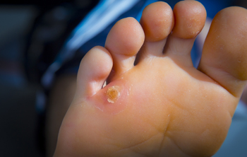 Soft corns on feet new arrivals
