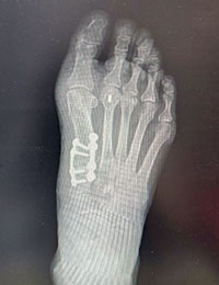 bunion surgery before and after