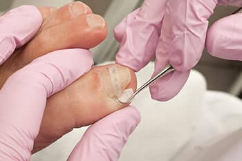 Ingrown toenail treatment in the Johnson County, KS: Overland Park (Leawood, Prairie Village, Shawnee, Lenexa, Olathe, Craig, Merriam) areas. We also serve Shawnee Mission and Kansas City, KS, and Kansas City, Lees Summit, and Independence, MO areas