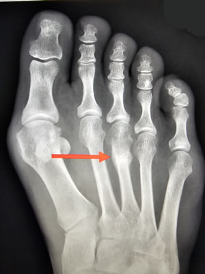 stress fractures