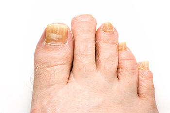 Toenail fungus treatment in the Johnson County, KS: Overland Park (Leawood, Prairie Village, Shawnee, Lenexa, Olathe, Craig, Merriam, Fairway, Stilwell, Mission, Roeland Park, Westwood) areas. We also serve Shawnee Mission and Kansas City, KS, and Kansas City, Lees Summit, and Independence, MO areas.