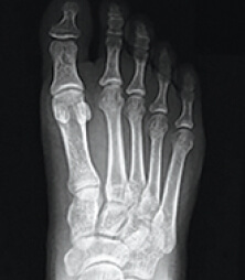 xray of bunion in the Overland Park, Kansas area