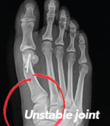 xray of bunion in the Overland Park, Kansas area