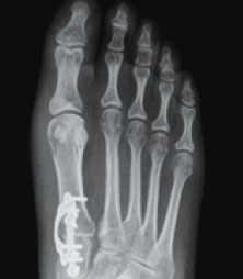 xray of bunions in the Overland Park, Kansas area