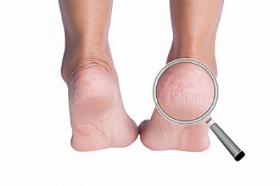 What Caused My Cracked Heels