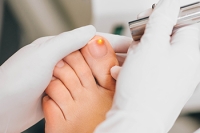 Pros and Cons of Laser Treatment for Toenail Fungus